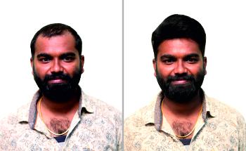 Non-Surgical Hair Replacement In Hyderabad, Bangalore, Vijayawada,  Vizag,Tirupati, rajamundry -RKHairStudio